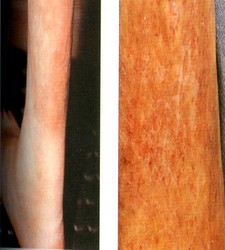Oker dermatitis